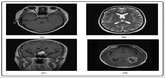 CoEIA Publishes Research Combining Blockchain and Deep Learning for Brain Tumor Prediction